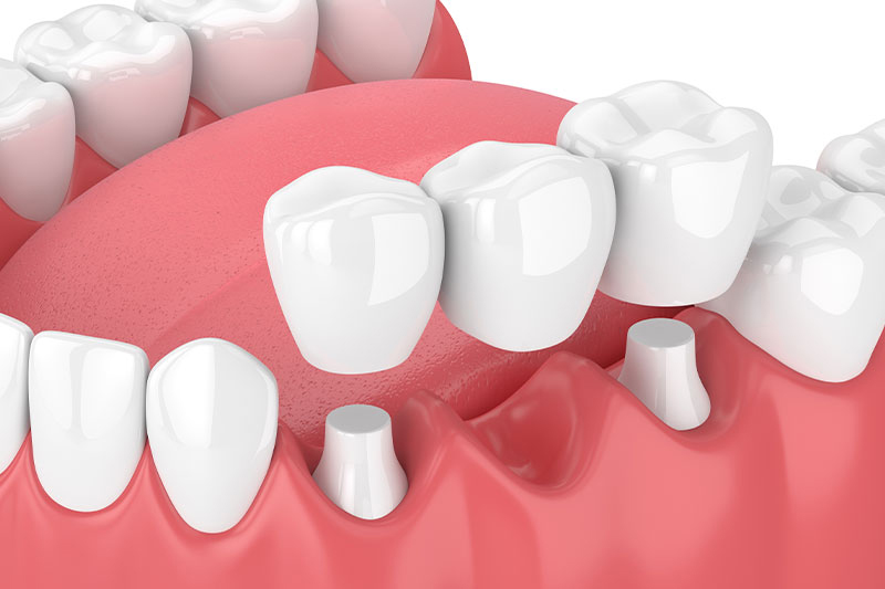 Dental Bridges in Massapequa