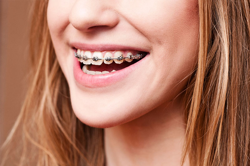 Orthodontics in Massapequa