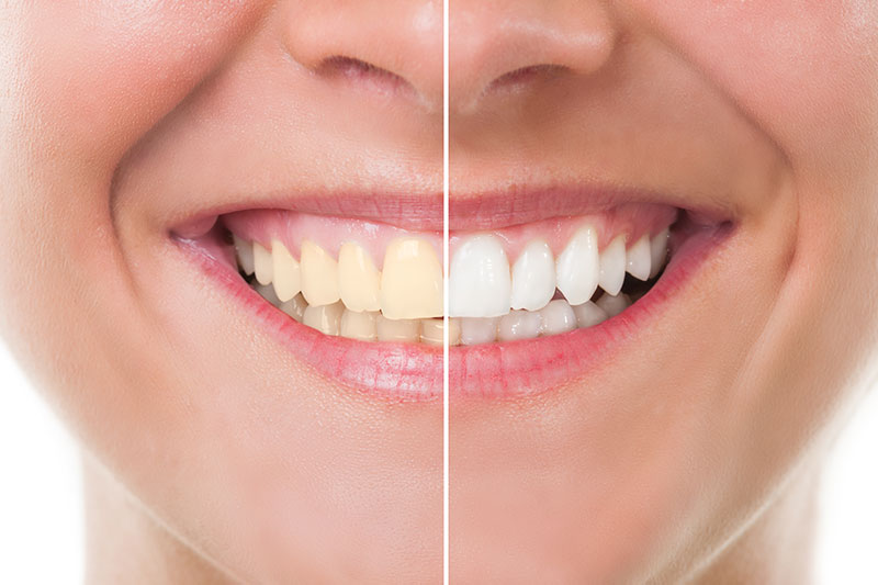 Teeth Whitening in Massapequa